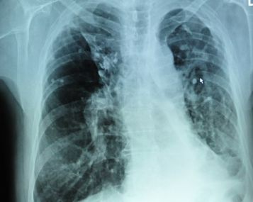 kodėl sergant tuberkulioze svoris mažėja kaip numesti svorio virš 55 metų