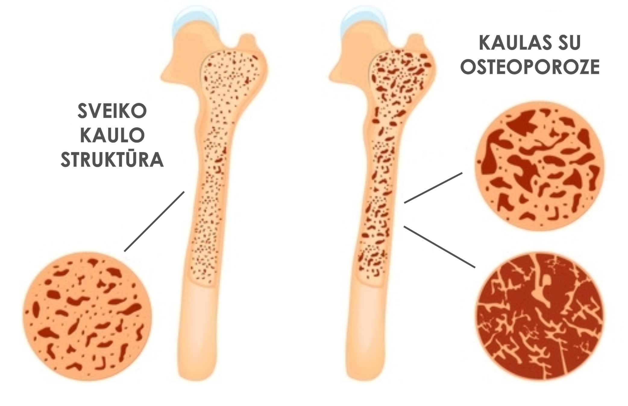 sunkus osteoporozės svorio kritimas