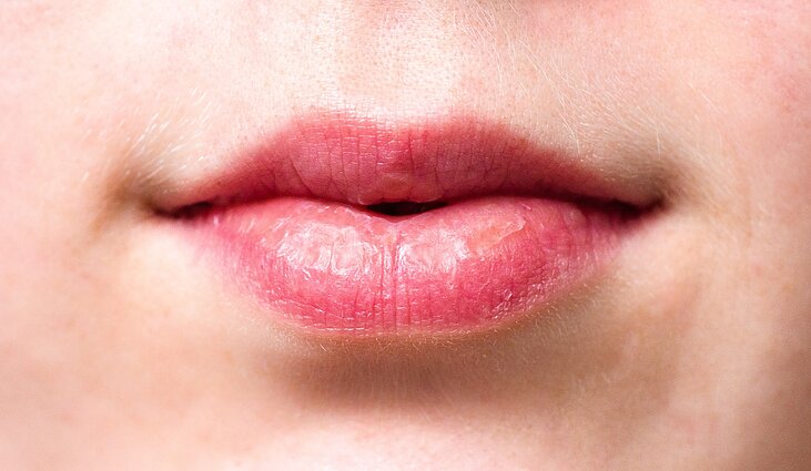kaip pašalinti riebalines lūpas