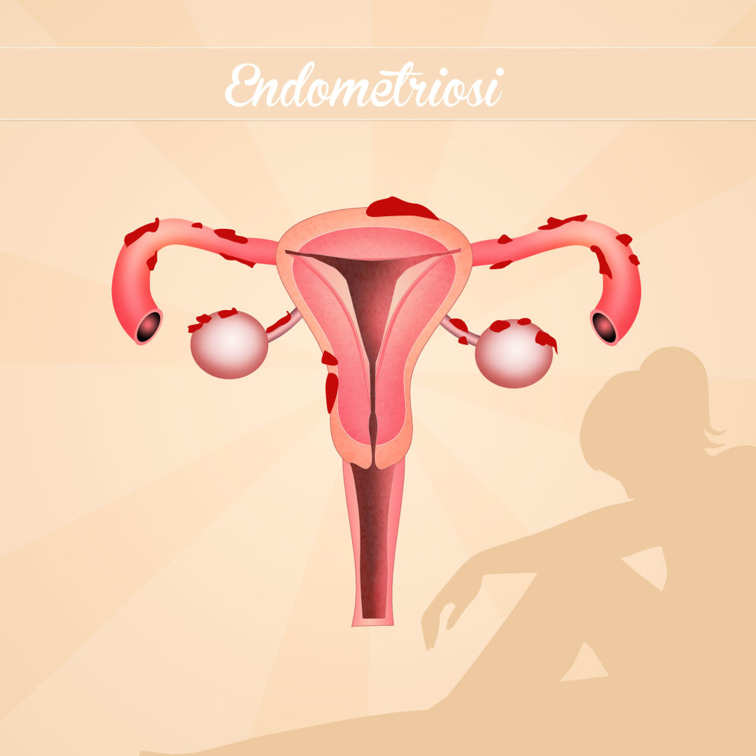 negalintis numesti svorio endometriozė sveikas svoris mesti nėščia